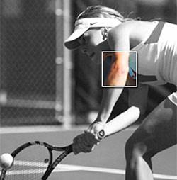 Tennis Elbow? Try This