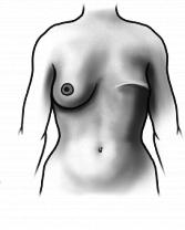 after a mastectomy