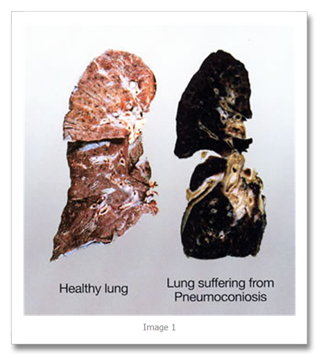 Rapid Revision: Rheumatoid Pneumoconiosis