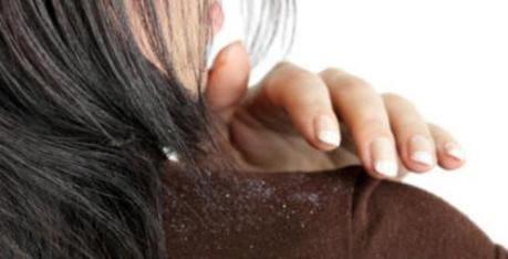 Baking Soda to Cure Dandruff and Promote Hair Growth