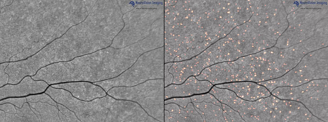 Amyloid Plaques in Retina