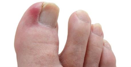 Ingrown Toenails Ingrown Toenails