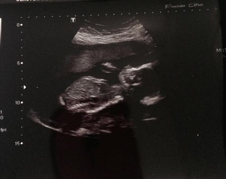 Pregnancy update - 20 Weeks.
