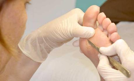 How to Get Rid of Calluses on Feet Calluses-Feet-1