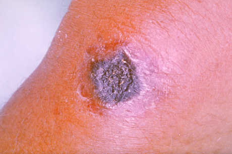 Anthrax Lesion on Skin (
