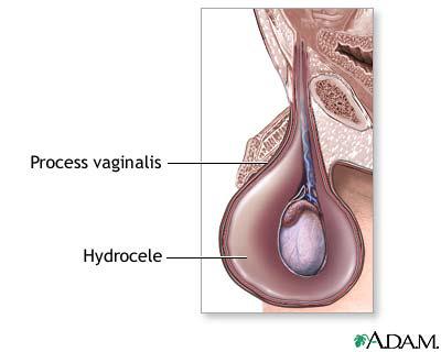 You Got To Know About Hydrocele!