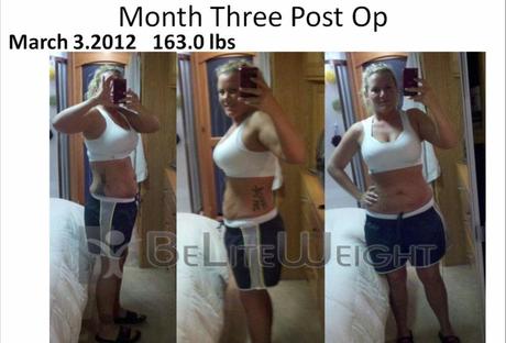 Stephanie’s Gastric Sleeve Weight Loss Journey