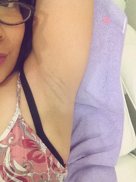 Underarm Laser Hair Removal After 3 Sessions Pic