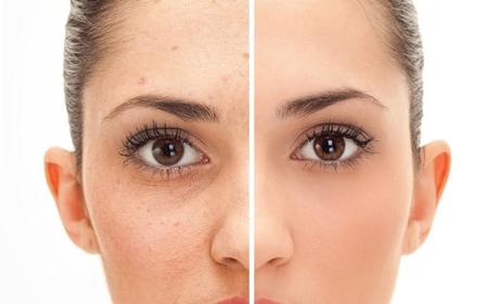 6 Ways to Get Rid Of Body Acne Ways to Get Rid Of Body Acne