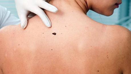 6 Ways to Get Rid Of Body Acne Body Acne