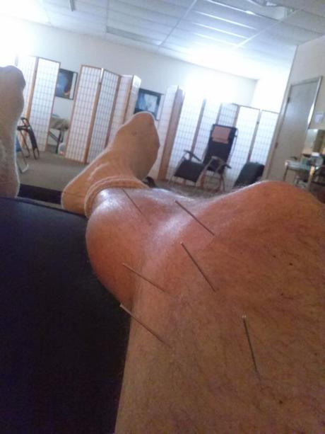 Acupuncture for Runners?