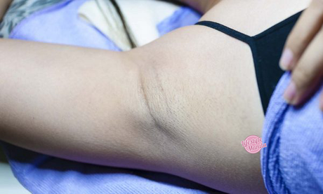 Skin Philosophie Underarm Laser One Month After First Session