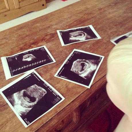 Could aspirin have saved our last 3 babies? Could aspirin have saved our last 3 babies?