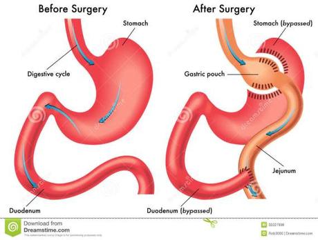 laparoscopic sleeve gastrectomy - weight loss surgery