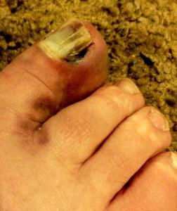 A Rumble, women talking about their sex lives, Fringe awards and my big toe My damaged big toe