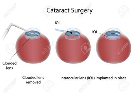 Cataract Eye Surgery – Is it safe and effective?