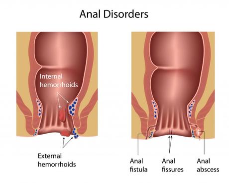 Ayurvedic Herbal Treatment for Fistula-in-ano