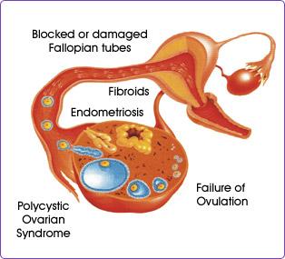 Acupuncture Points for Treating Female Infertility Acupuncture Points for Treating Female Infertility