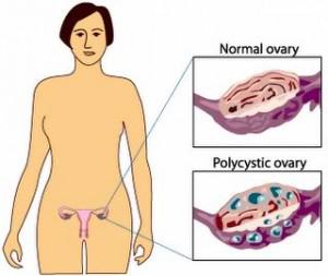 How Dangerous Is PCOS Syndrome?