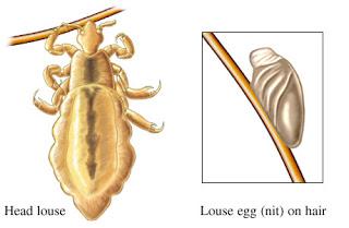 lice momday comb led nyda treatment head paperblog