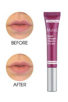 Rapid Collagen Infusion for Lips