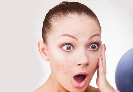 7 Mistakes we make when we have zits Touching Zits