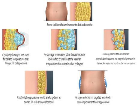 Cryolipolysis: Get Your Slim Body Back In A Month!