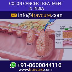 Colon Cancer Treatment & Surgery:  What should You Know?