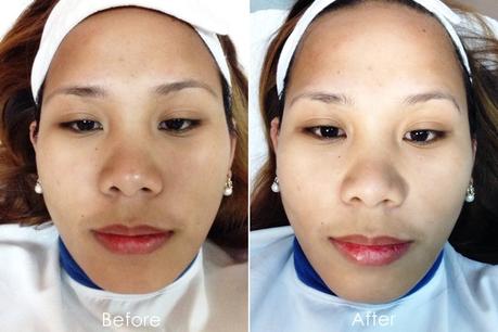 My Dermclinic Intense Diamond Peel Experience My Dermclinic Intense Diamond Peel Experience