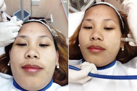 My Dermclinic Intense Diamond Peel Experience My Dermclinic Intense Diamond Peel Experience