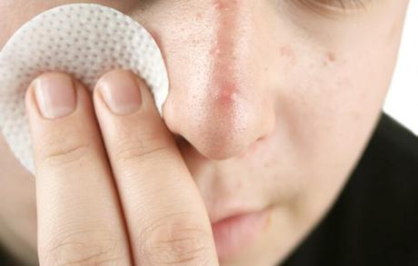 how to get rid of blackheads in your ears