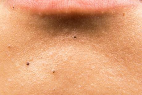 how to get rid of whiteheads and blackheads
