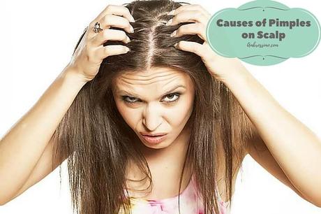 Scalp Acne Causes