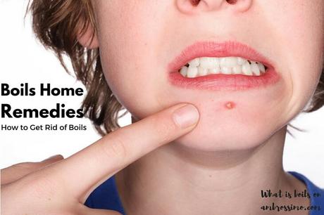 Home Remedies for Boils