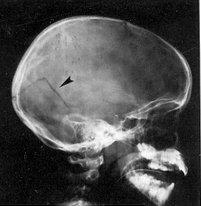 English: Linear Skull Fracture with arrow poin...