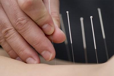 Traditional Chinese Medicine: That Time I Tried Acupuncture in China….Alone! acupuncture china xian