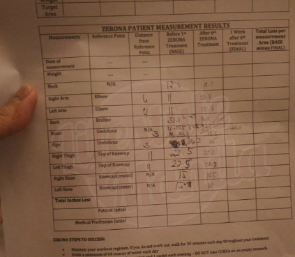 Contours LaserFit: Non-invasive fat-busting solution Zerona Patient Measurement 2 weeks