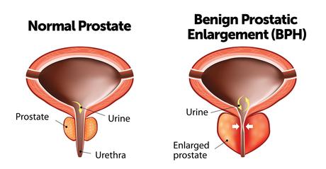 Natural Ayurvedic Treatment of Enlarged Prostate
