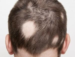 alopecia- areota