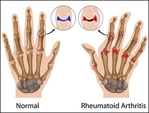 Natural Cure for Rheumatoid Arthritis