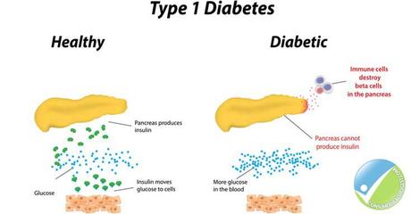 Lifestyle and Home Remedies for Type 1 Diabetes