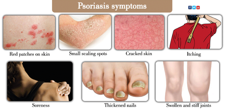 How to Treat Psoriasis at Home-Herbal Remedies for Psoriasis