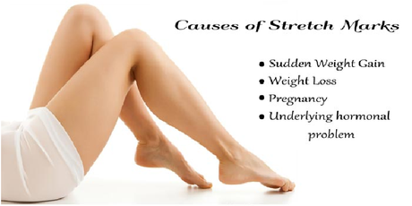 what-causes-stretch-marks-02