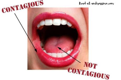 Canker Sores Contagious
