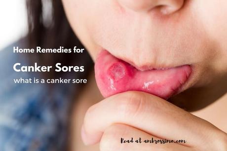 what is a canker sore