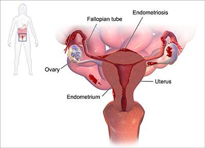 Natural Cure for Endometriosis