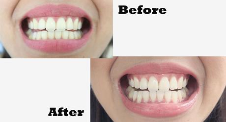 Teeth Whitening Treatment and Tips | Shinagawa Orthodontics & Aestheic Dentistry