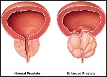 Herbal Medicine to Control Prostate Enlargement