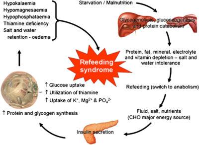 Fasting and Re-Feeding Syndrome