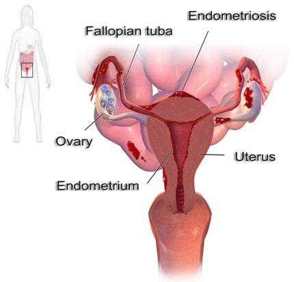 IS THERE ANY HERBAL REMEDY FOR ENDOMETRIOSIS TREATMENT?